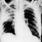 Pneumonie - entzündliche Erkrankung der Lunge